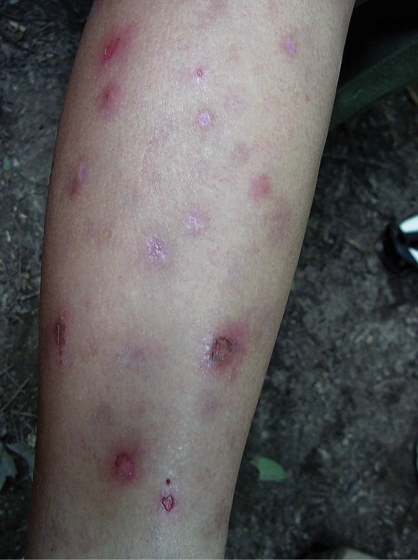 A person's leg is covered with mosquito bites, some of them scratched raw.